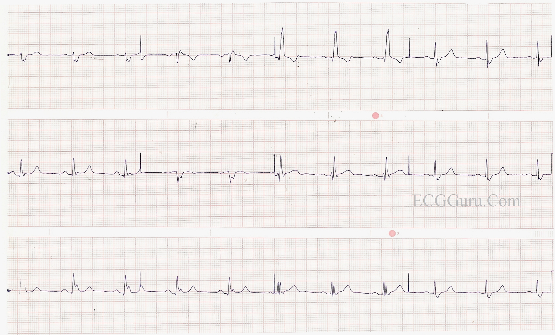 Right Bundle Branch Block With Left Posterior Fascicular Block | ECG